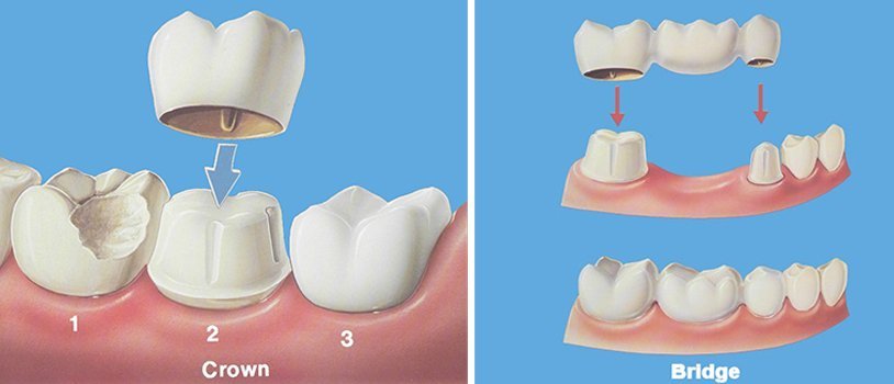Diagram demonstrating the placement of a dental crown over a prepped tooth and a dental bridge restoring missing teeth.