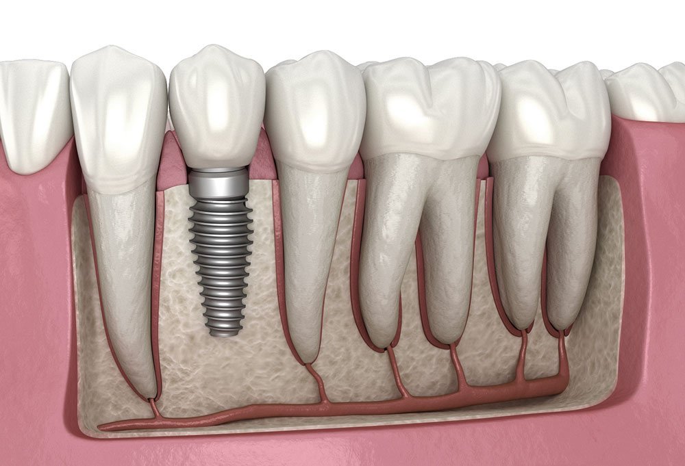 Dental implant placed in the jawbone to replace a missing tooth