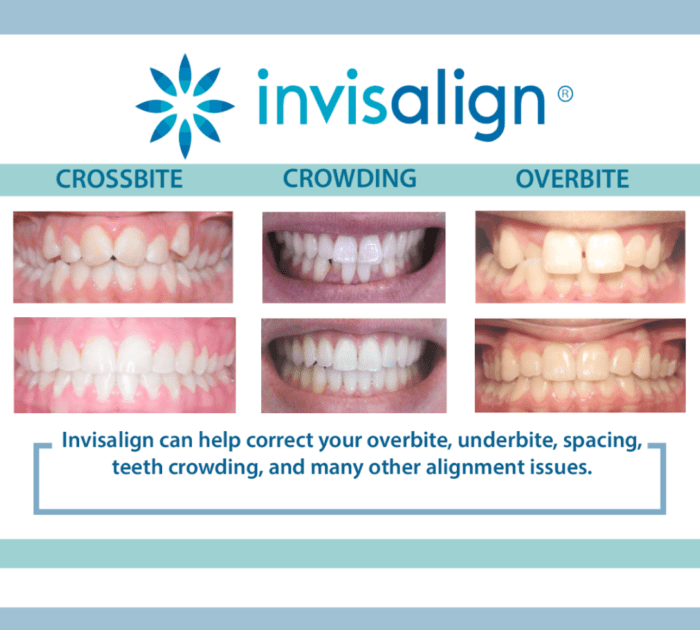 Before and after comparison of Invisalign treatment correcting crossbite, crowding, and overbite alignment issues.