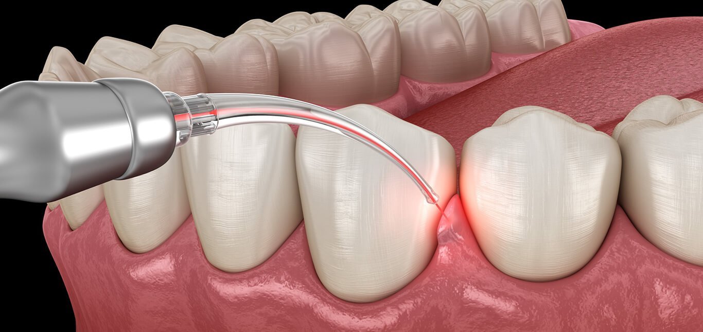 Laser dentistry treatment for gum disease and precise dental care